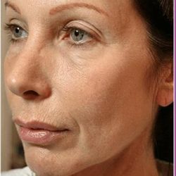 Thermage Before & After Patient #1587